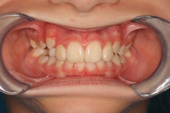 Crowding, Jaw Development before 296527