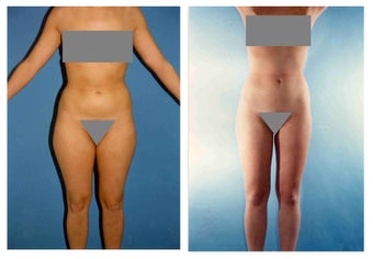 Liposuction before 636295