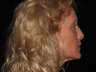 Botox and Restylane 323691