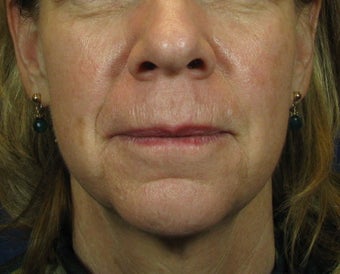 Laser Facelift before 249014