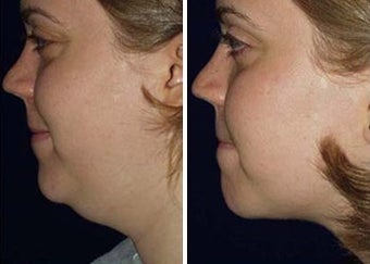 Liposuction of Chin before 6801