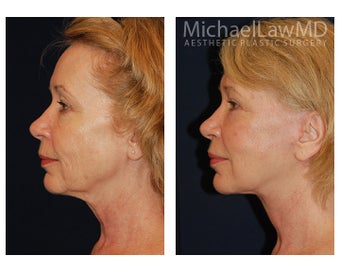Facial Rejuvenation 395138