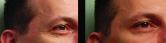 BOTOX before 460594