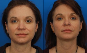 Ultherapy before 411575