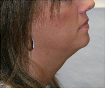 SmartLipo of Neck - Right Lateral View after 109277