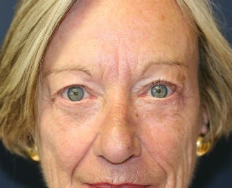 eyelid blepharoplasty after 378922