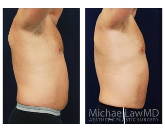 Liposuction 495045