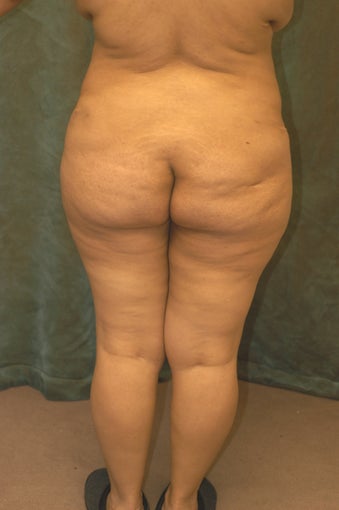 Women's Buttocks Augmentation before 518121