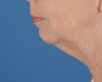 Chin Implant before 504101