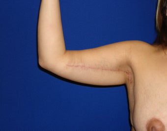 Arm lift after 250923