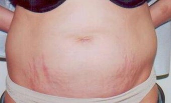 Laser Skin Resurfacing with Smartxide DOT Therapy after 238267