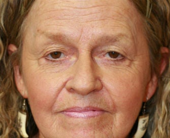 Upper Eyelid Blepharoplasty and Corner of Lip Lift before 326447