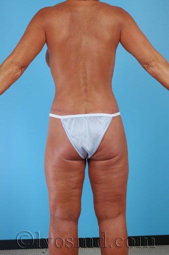 Lower Body Lift, Inner Thigh Lift after 255921
