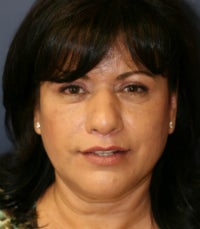 Lip Lift after 605285