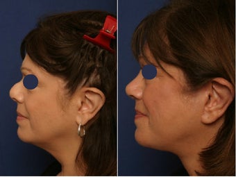 Revision rhinoplasty before and after before 78517