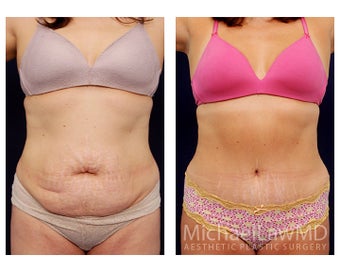 Abdominoplasty - Tummy Tuck before 396126