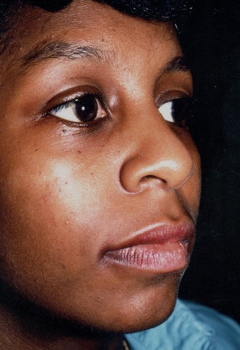 Rhinoplasty 383007