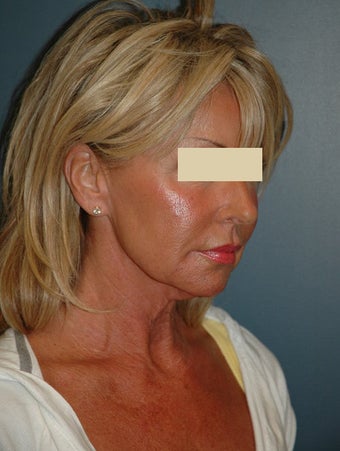 Facelift before 137049