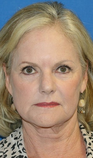 Short Incision Facelift and Lateral Browlift before 392431