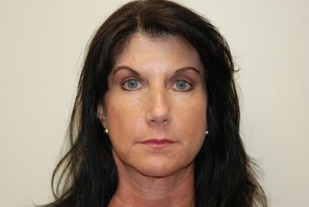 Forehead reconstruction after MOHS surgery and Left Brow Lift For Symmetry after 399860