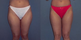 Tumescent Liposuction before 78391