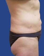 Abdomen Liposuction after 513402
