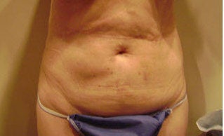 Tummy Tuck before 172689