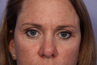 Eyelid Surgery after 306447