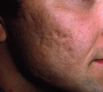 Acne Scarring before 157588