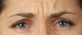 Botox before 391578