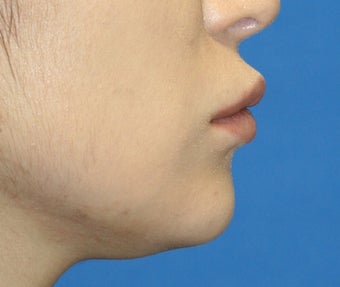 Lip Reduction before 250836
