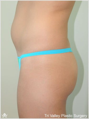 Brazilian Buttock Lift before 420880