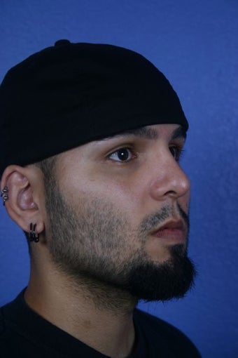 Revision Rhinoplasty after 418919
