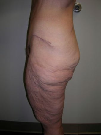 Thigh Lift before 259011