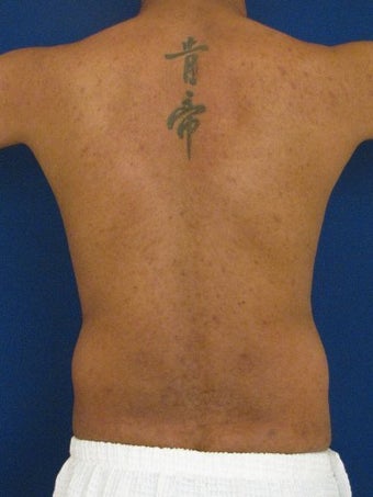 Vaser Hi Def Liposuction of the abdomen, chest, back, and flanks with fat injections to the pectoralis region before 422700