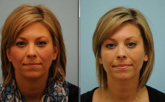 Short Term Botox before 515450
