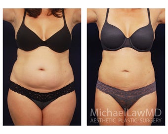 Liposuction before 392397