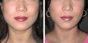 Jaw before 431338