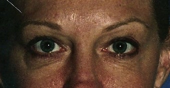 Upper and lower eyelid (blepharoplasty) Surgery before 283894