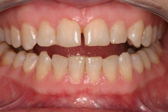 porcelain crowns to close space before 336722