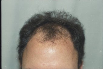 Hair Transplantation before 109450