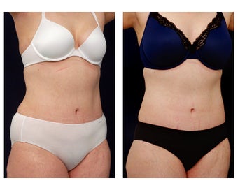 Liposuction after 397021