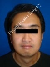 Ear Surgery (Otoplasty) 584554