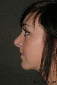Chin Augmentation & Rhinoplasty after 565873