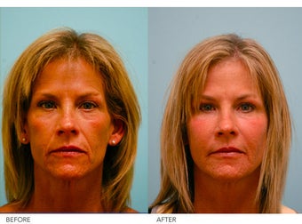 Fat Transfer/Fat Grafting/Facial Rejuvenation before 136360