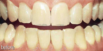 Whitening aging teeth before 234632