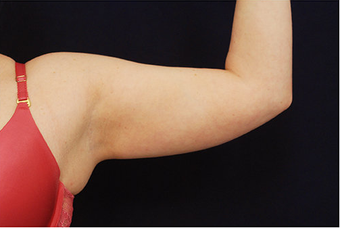 Liposuction before 397154