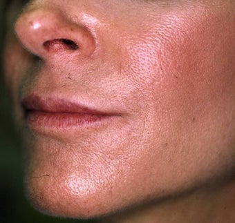 Correction of Facial Aging Grooves after 157597