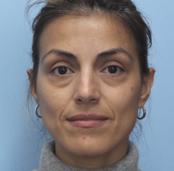Eye Dermafillers,Cheek Dermafillers,Facial Dermafillers before 454584