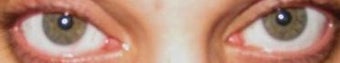IBRITE Eye Whitening after 574411